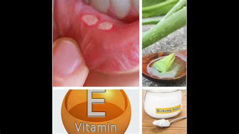 Natural Home Remedies For Canker Sore Youtube