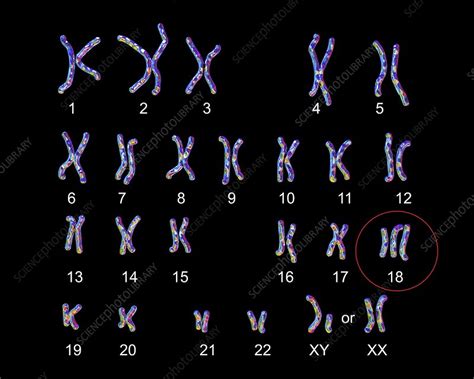 Edward S Syndrome Karyotype Illustration Stock Image F013 4427