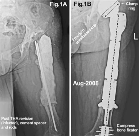 Patient Radiographs Illustrating A Girdlestone Hip That The Patient