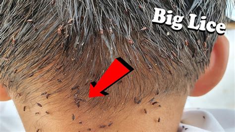 Oh Wow A Lots Giant Lice On Boys Head Lice Removing Youtube