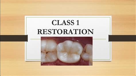Class 1 Restoration Composite Filling ️👌 Youtube