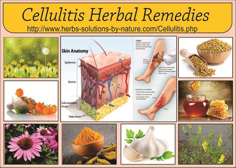 12 Herbal Remedies For Cellulitis Bacterial Skin Infection Herbs