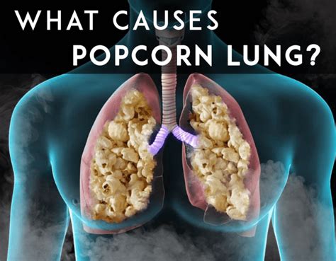 Is Popcorn Lung A Genuine Risk E Liquids Uk