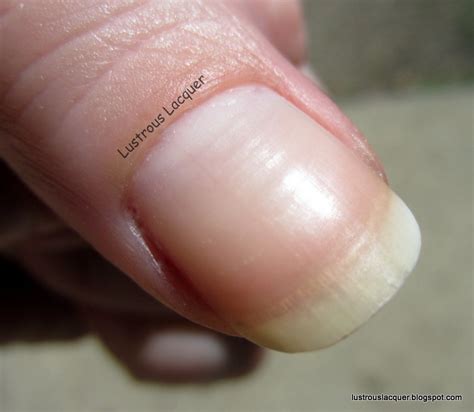 21 Why Do My Thumb Nails Have Horizontal Ridges Petersmini Onpage