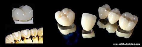 Pfm medical is a globally active industrial medical technology company with headquarters in cologne. pfm crown denture manufacturers exporters india punjab ...