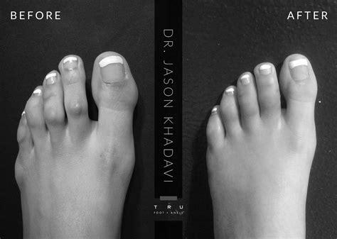 Hammer Toe Before And After