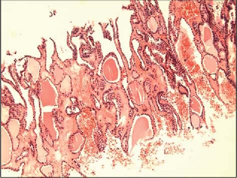 Aspiration Biopsy Cytology Of Ectopic Thyroid Tissue In The Lateral