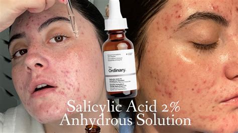 TESTING THE ORDINARY SALICYLIC ACID ANYDROUS SOLUTION FOR WEEKS ON HORMONAL ACNE SKIN YouTube