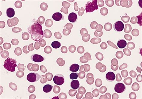 Chronic Lymphocytic Leukemia Cll Oncology Medbullets Step 1