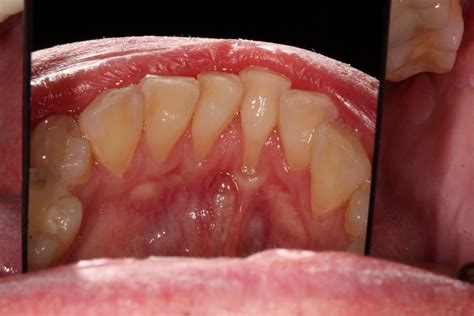 Frenectomy Southern Roots Periodontics