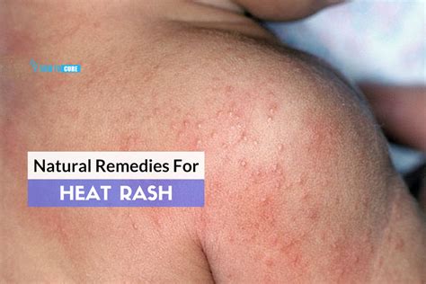 5 Incredible Home Remedies For Heat Rash How To Cure