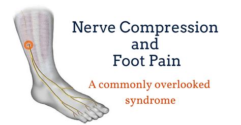 Foot Pain Due To A Nerve Entrapment Gray Chiropractic Stcatharines