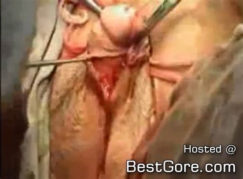 Female To Male Sex Reassignment Surgery Video Best Gore