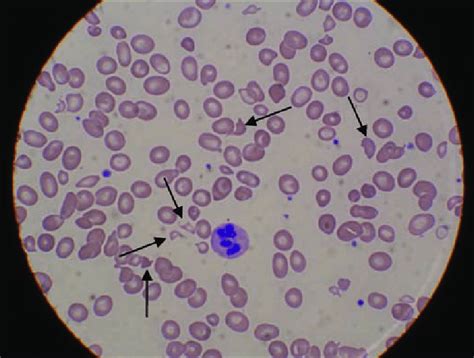 Peripheral Smear Showing A Hypersegmented Neutrophil And Multiple
