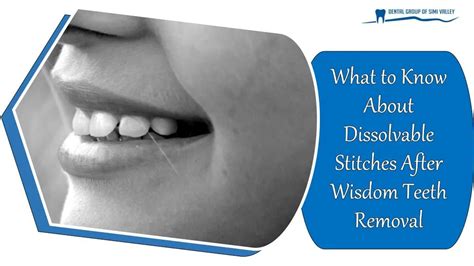 Ppt What To Know About Dissolvable Stitches After Wisdom Teeth