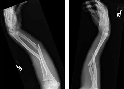 Broken Arm Compound Fracture