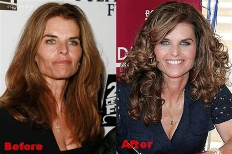 Maria Shriver Plastic Surgery Before And After Face Photos Plastic