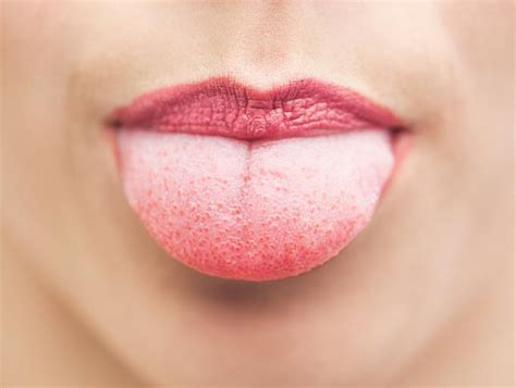 por qué siento la lengua escaldada y cómo curarla
