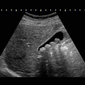 Камни в желчном пузыре, Желчнокаменная болезнь : симптомы, лечение Картинка - Камни в желчном пузыре, Желчнокаменная болезнь : симптомы, лечение