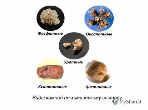 Мочекаменная болезнь диета какие Мочекаменная Болезнь Виды Камней Диета — Похудение Диета Правильное Питание Мочекаменная Болезнь Виды Камней Диета — Похудение Диета Правильное Питание Мочекаменная болезнь диета какие