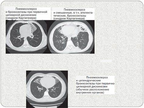 Диета 5 дискинезия Первичная цилиарная дискинезия у детей - online presentation Первичная цилиарная дискинезия у детей - online presentation Диета 5 дискинезия