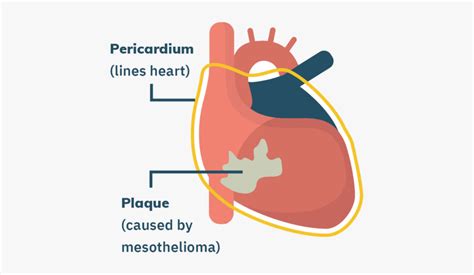Pericardial Mesothelioma Free Transparent Clipart Clipartkey