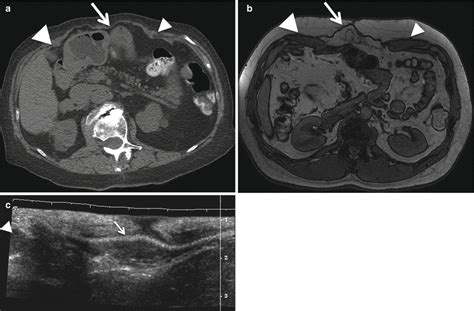 Cross Sectional Imaging Of The Abdominal Wall Radiology Key