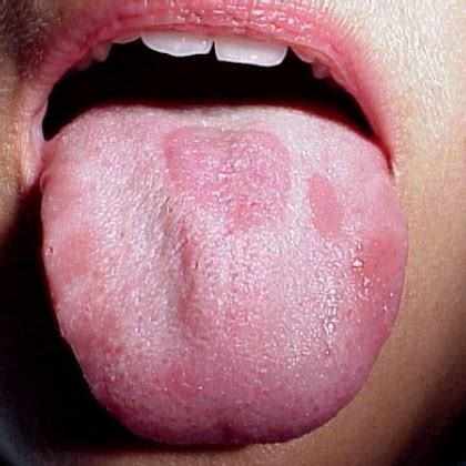 This discomfort may affect the tongue, gums. SUGAR REMEDY FOR BURNT TONGUE