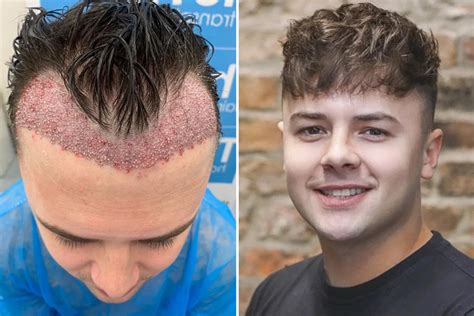 Brit 26 Left With Horrific Scars After Botched £1250 Hair Transplant