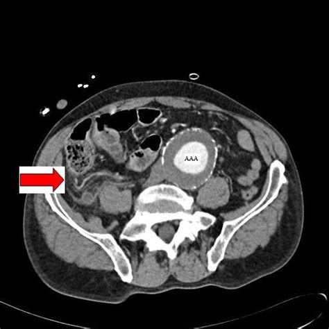 Abdominal Ct Image With Contrast Taken On The Day Of Ad Open I