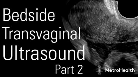 Bedside Transvaginal Ultrasound Part 2 Youtube