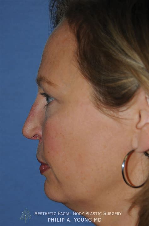 Rhinoplasty Before And After Photos Seattle Bellevue