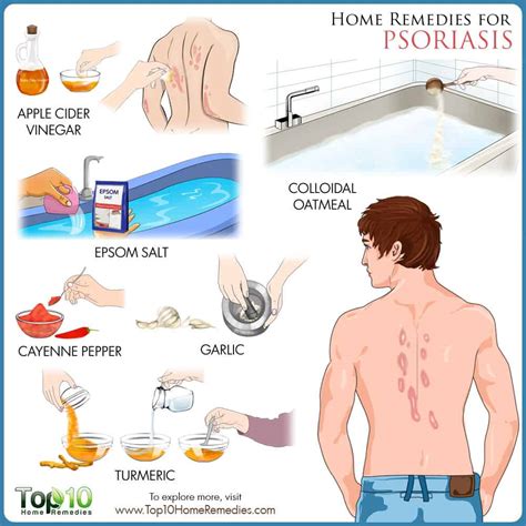 Home Remedies For Psoriasis Top 10 Home Remedies