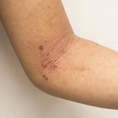 Update On Pediatric Atopic Dermatitis MDedge Dermatology