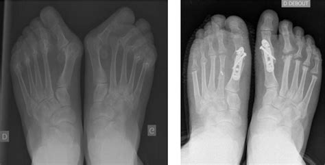 Rheumatoid Forefoot Reconstruction In Nonrheumatic Patients Lesser