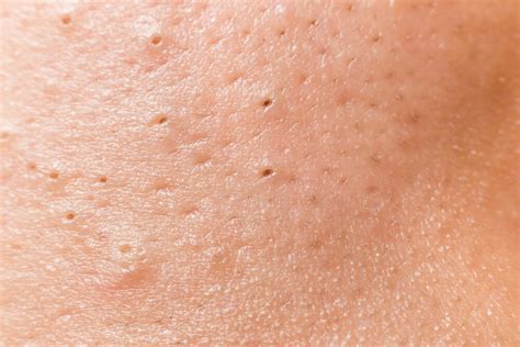 Understanding And Treating Enlarged Pores Cosmedixuk