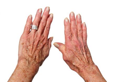Dna moczanowa artretyzm podagra jakie są przyczyny objawy i metody leczenia Zouza pl