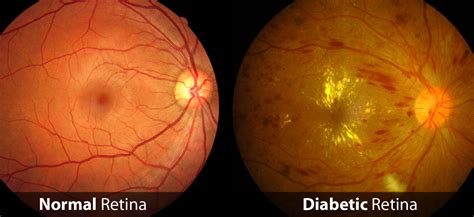 Retina Raleigh Diabetic Retinopathy Raleigh Raleigh Ophthalmology