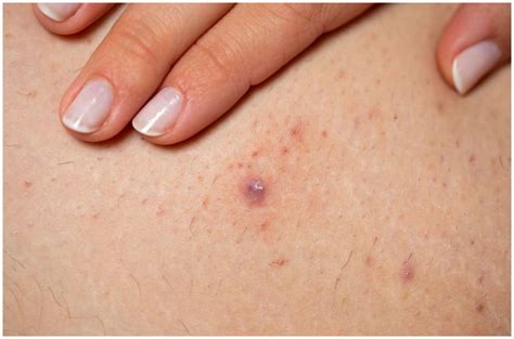 Then i thought it was an ingrown hair but pictures online look kind of like herpes? Folliculitis vs Herpes - Symptoms, Causes, Pictures ...