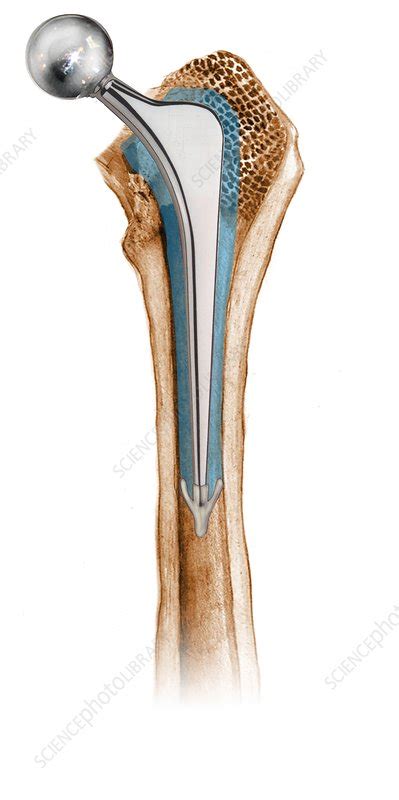 Prosthetic Hip Joint Artwork Stock Image C0166782 Science Photo