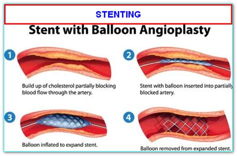 Facts About Stent Angioplasty Or Ptca