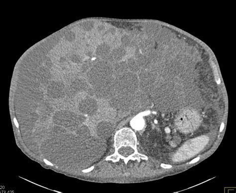 Polycystic Liver Disease Liver Case Studies Ctisus Ct Scanning
