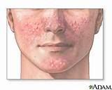 Pictures of What''s The Best Acne Treatment