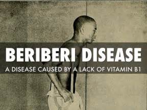 Beriberi Disease By Rosie Sawrey Cookson