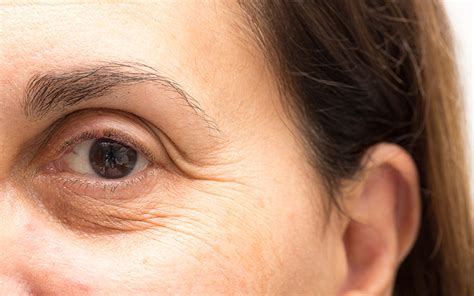 How To Treat Dry Skin Around Your Eyes With Ayurvedic Solutions Vedix