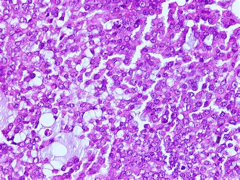 Pathology Outlines Extrarenal Rhabdoid Tumor