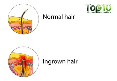 Folliculitis is an infection of the hair follicle that is often accompanied by pustules that look like boils. Home Remedies for Ingrown Hair | Top 10 Home Remedies