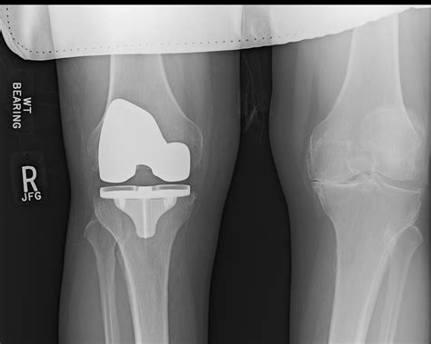 Ortho Dx Pain And Swelling Following Knee Replacement Clinical Advisor