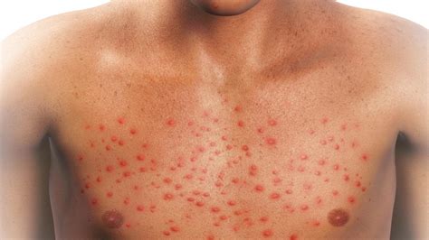 What Could Cause A Red Rash All Over The Body