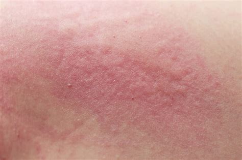 Cutaneous Candidiasis Causes Risk Factors Signs Symptoms Diagnosis And